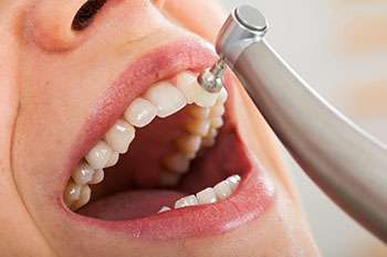 Diş taşı temizliği nedir?