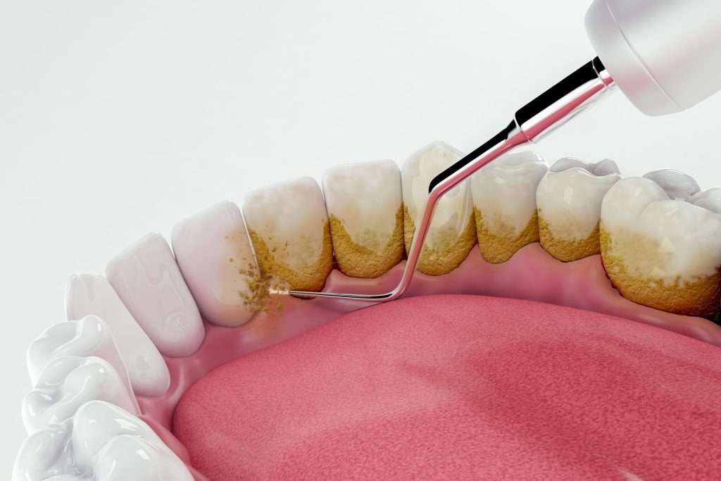 Diş taşı temizliği nasıl yapılır?