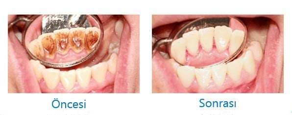 Diş taşı öncesi ve sonrası