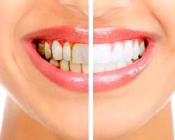 Diş Taşı Temizliği Nedir? Nasıl Yapılır?